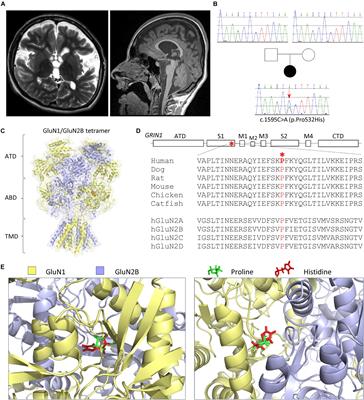 A de novo GRIN1 Variant Associated With Myoclonus and Developmental Delay: From Molecular Mechanism to Rescue Pharmacology